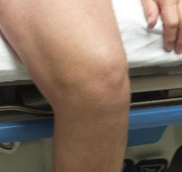 Left Knee Total Replacement - 17MAR15