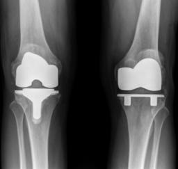Right Knee Total Joint Replacement Surgery - 25AUG19